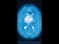 China brain tech rivals Musk’s Neuralink